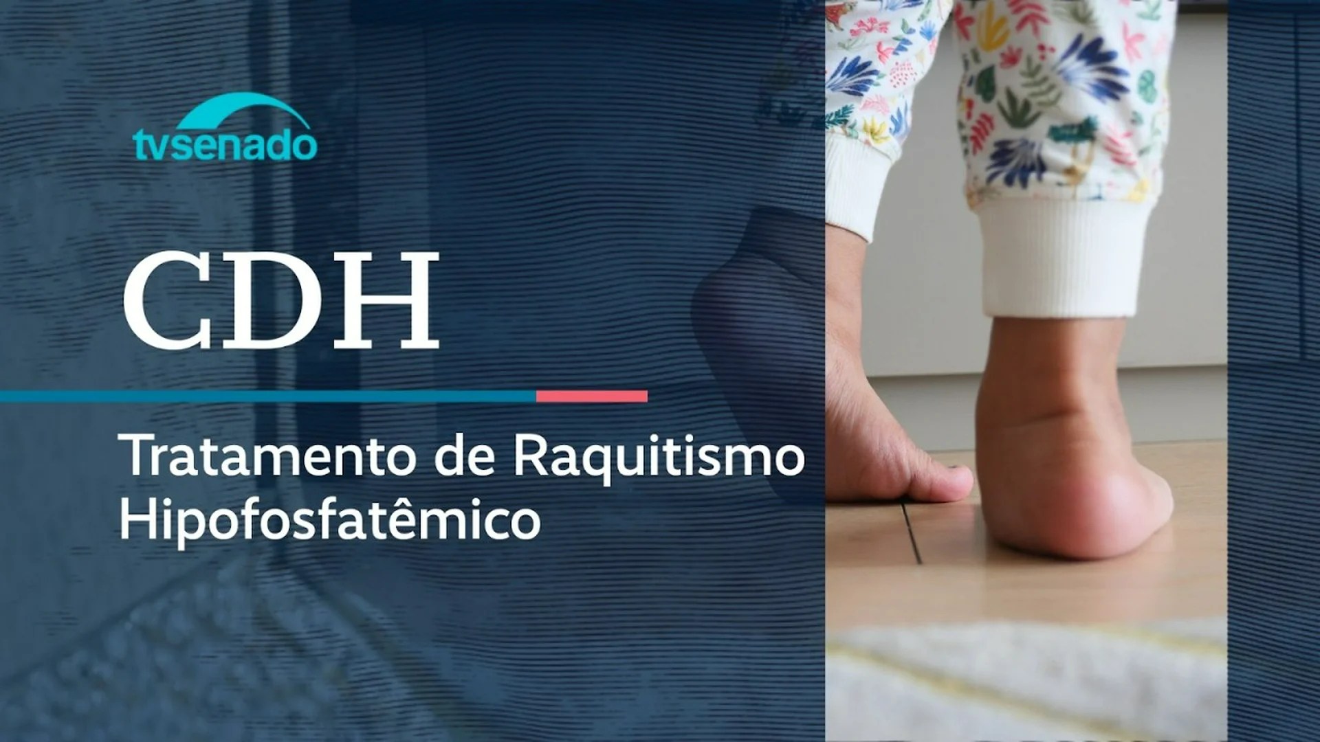 Vídeo: Ao vivo: CDH debate tratamento do raquitismo no SUS – 23/4/26 Vídeo: Ao vivo: CDH debate tratamento do raquitismo no SUS – 23/4/26