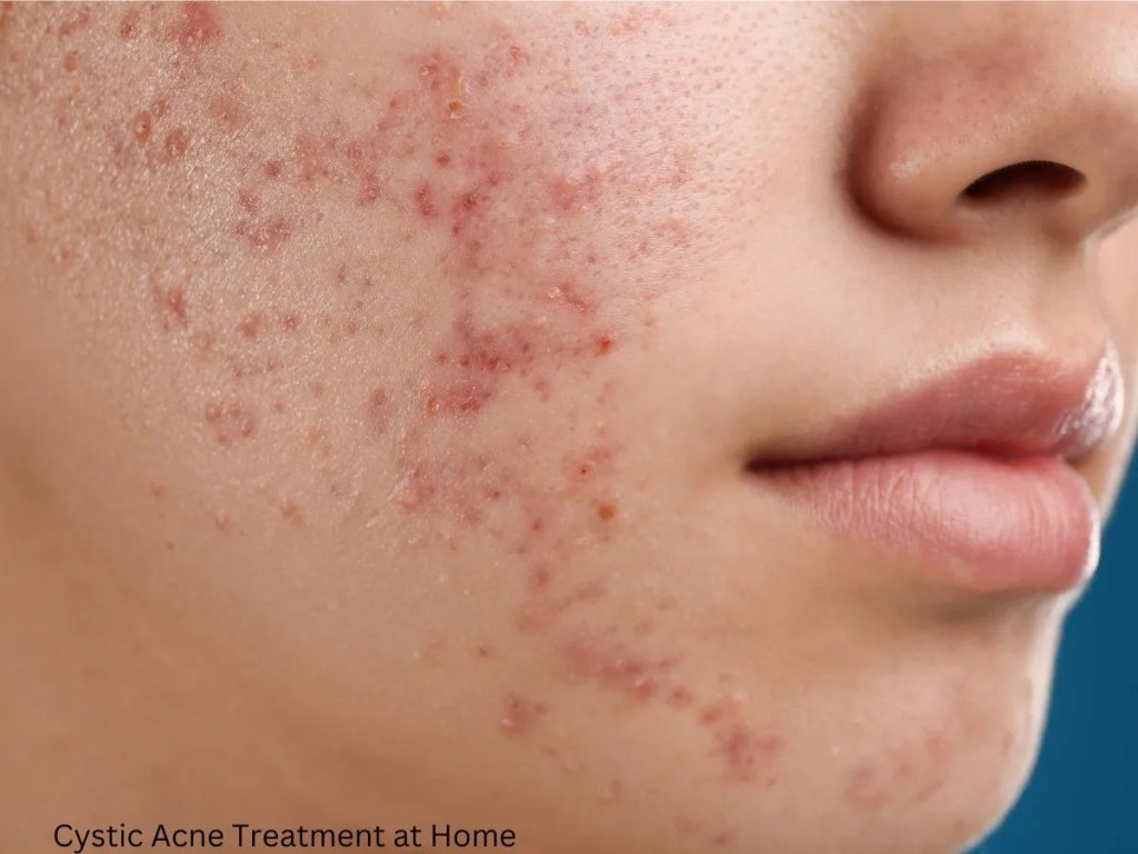 Treating cystic acne at home Treating cystic acne at home
