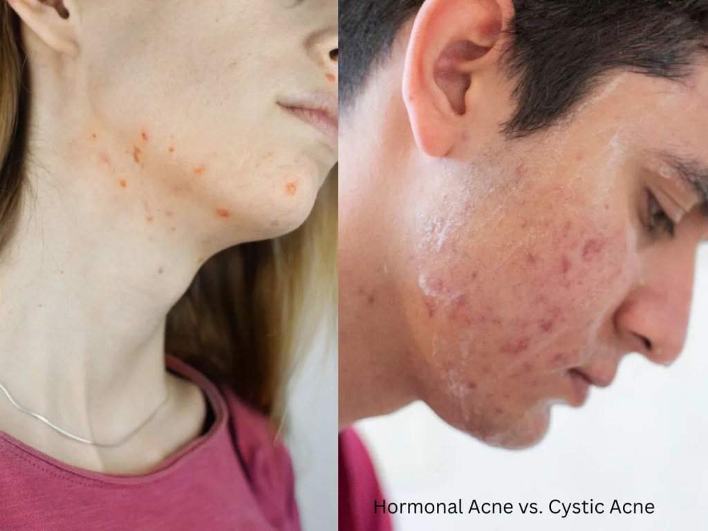 Hormonal acne vs. cystic acne Hormonal acne vs. cystic acne