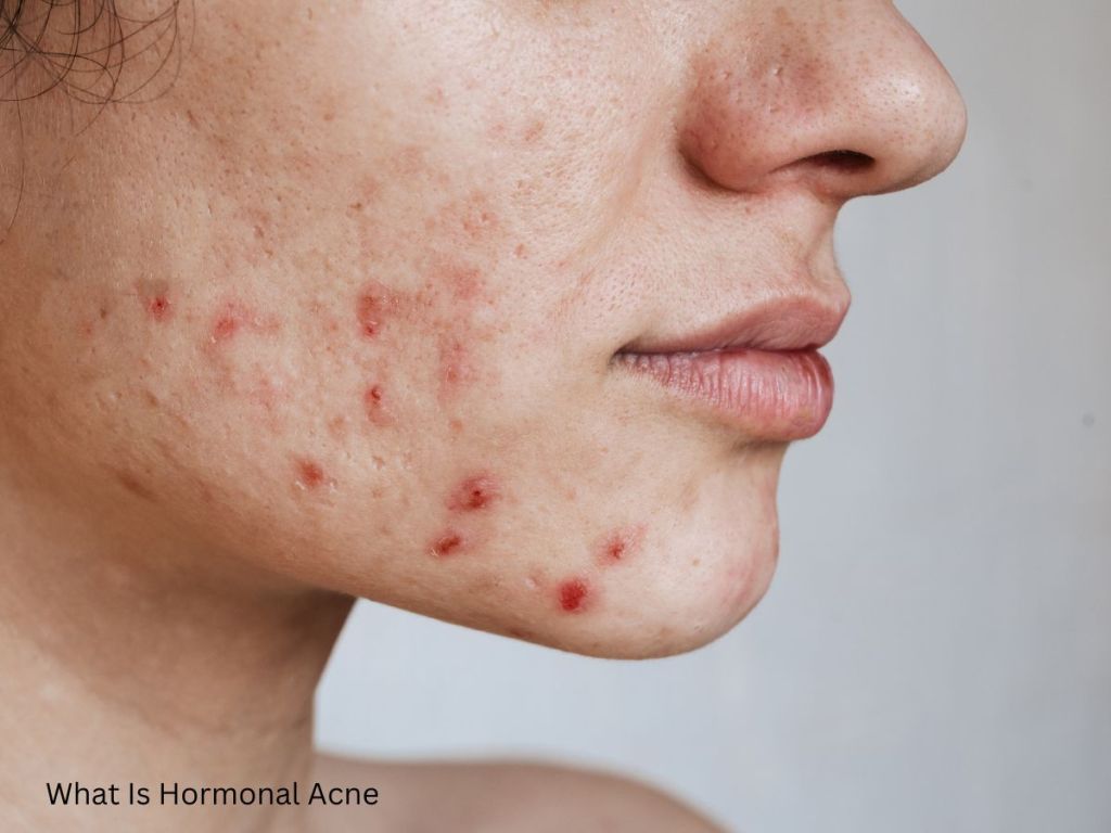 What is hormonal acne and how can I get rid of it? What is hormonal acne and how can I get rid of it?