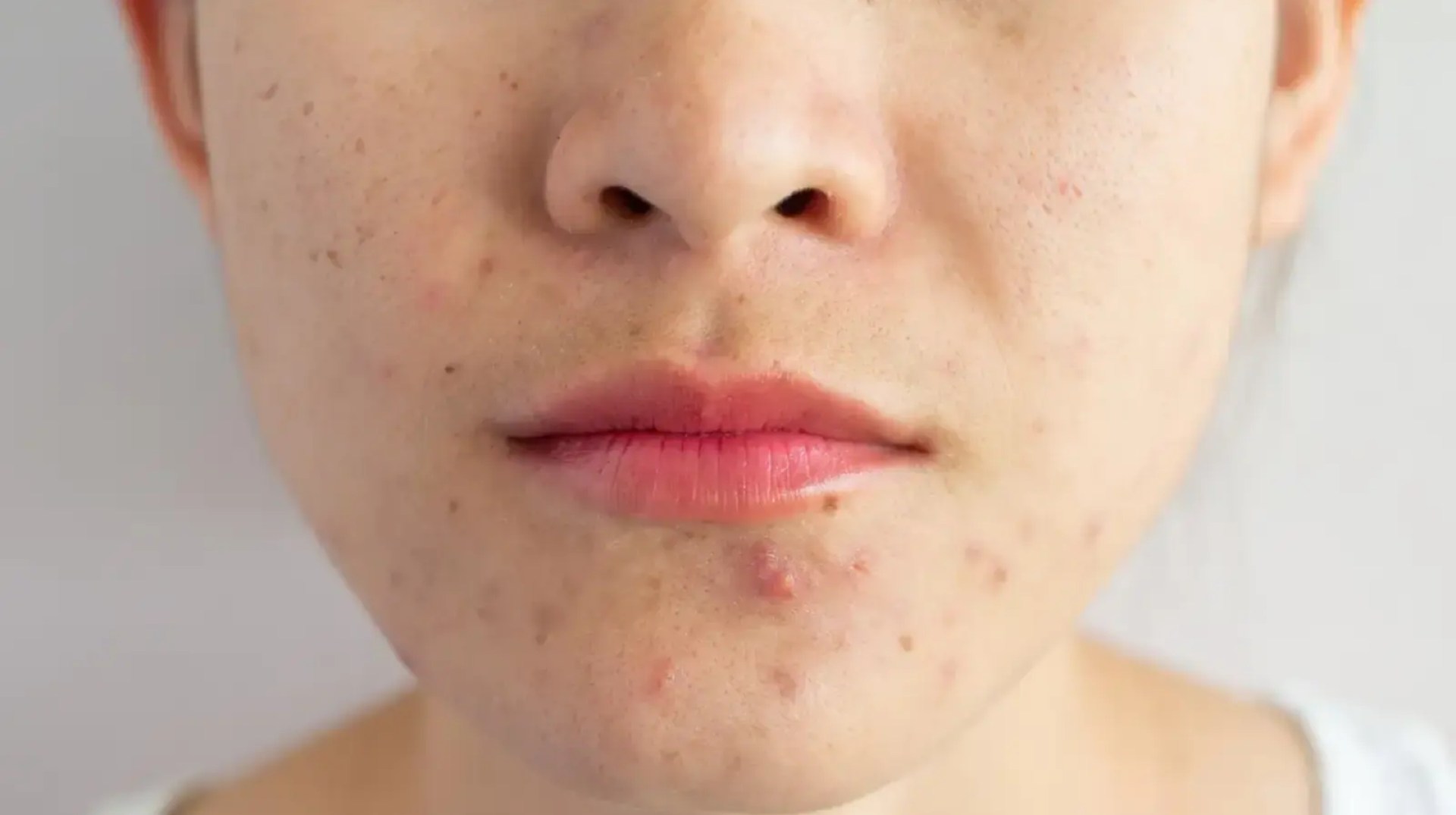 5 skincare hacks to fight acne when the season changes 5 skincare hacks to fight acne when the season changes