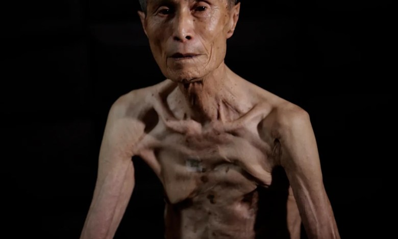 Powerful AP photos show scars of survivors of Nagasaki atomic bombing Powerful AP photos show scars of survivors of Nagasaki atomic bombing