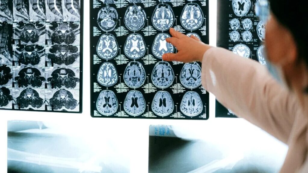 Descoperire revoluționară: Cum un mecanism al creierului poate încetini Alzheimer Descoperire revoluționară: Cum un mecanism al creierului poate încetini Alzheimer