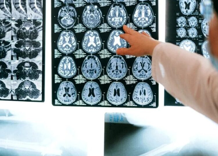 Descoperire revoluționară: Cum un mecanism al creierului poate încetini Alzheimer Descoperire revoluționară: Cum un mecanism al creierului poate încetini Alzheimer