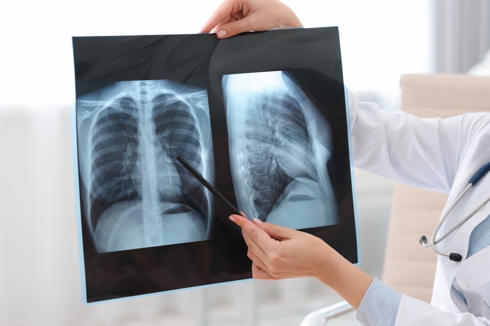 Diagramă a rezultatelor studiului fază III privind imunoterapia în cancer pulmonar celule mici, evidențiind prelungirea supraviețuirii pacienților. | sursa foto: News.ro Diagramă a rezultatelor studiului fază III privind imunoterapia în cancer pulmonar celule mici, evidențiind prelungirea supraviețuirii pacienților. | sursa foto: News.ro