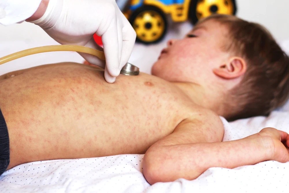 Medic de familie consultând un copil într-o clinică din Săcele, Brașov, în contextul epidemiei rujeolă România și scăderii ratelor vaccinare. | sursa foto: Adevarul Medic de familie consultând un copil într-o clinică din Săcele, Brașov, în contextul epidemiei rujeolă România și scăderii ratelor vaccinare. | sursa foto: Adevarul