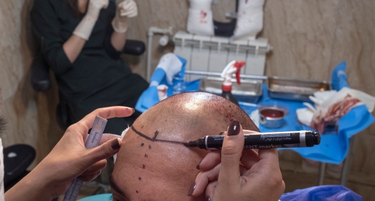 Prayers Up! Man Dies During Prep Phase Of His Second Hair Transplant Surgery In Turkey Prayers Up! Man Dies During Prep Phase Of His Second Hair Transplant Surgery In Turkey