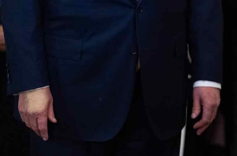 Trump diagnosed with vein issue after leg swelling and hand bruising Trump diagnosed with vein issue after leg swelling and hand bruising