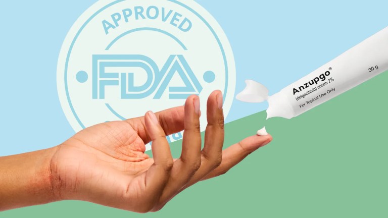 New Hand Eczema Treatment Anzupgo (Delgocitinib) Gets FDA Okay New Hand Eczema Treatment Anzupgo (Delgocitinib) Gets FDA Okay