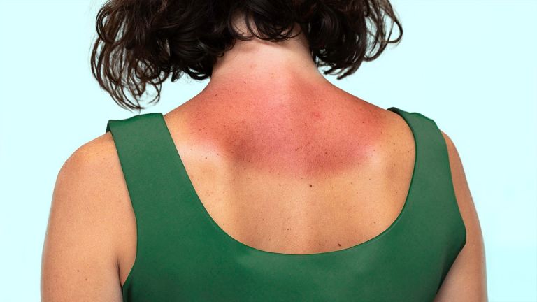 What Is Sun Poisoning? Plus, How to Prevent and Treat It What Is Sun Poisoning? Plus, How to Prevent and Treat It