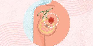 What Is Breast Cancer? Symptoms, Causes, Diagnosis, Treatment, and Prevention