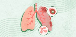 Understanding COPD: Symptoms, Causes, and Treatment Options