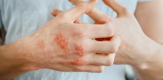 3 Signs of Uncontrolled Eczema to Watch Out For