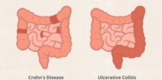 Crohn’s Disease vs. Ulcerative Colitis: What’s the Difference?