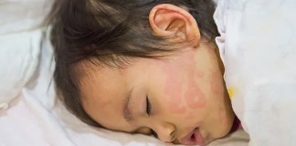 Managing Hives in Kids