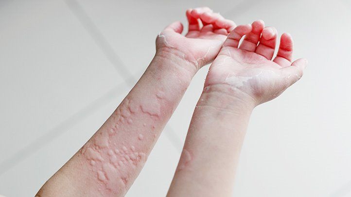 What Causes Hives? What Causes Hives?