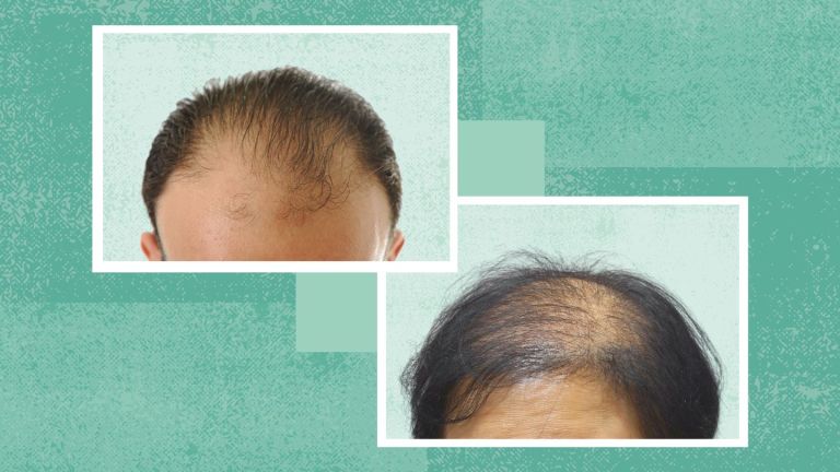Male vs. Female Pattern Baldness (Androgenetic Alopecia): What’s the Difference? Male vs. Female Pattern Baldness (Androgenetic Alopecia): What’s the Difference?