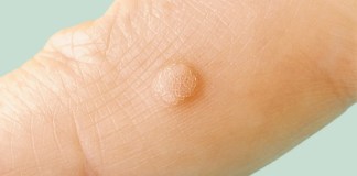 HPV Symptoms: Warts, Genital Warts, Cancer