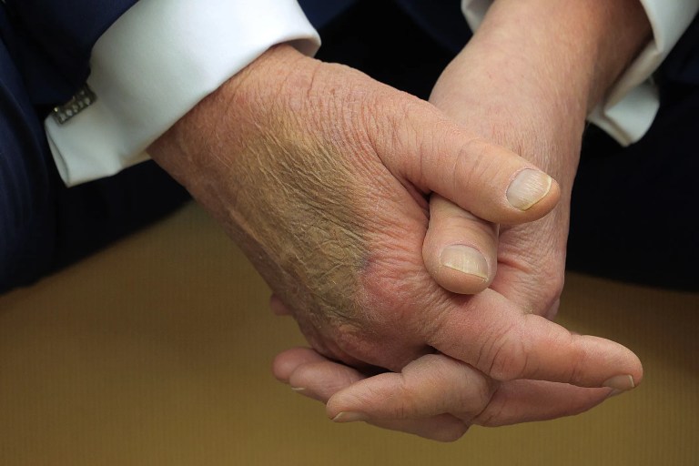 Trump Comes Up With Another Excuse for That Weird Bruise on His Hand Trump Comes Up With Another Excuse for That Weird Bruise on His Hand