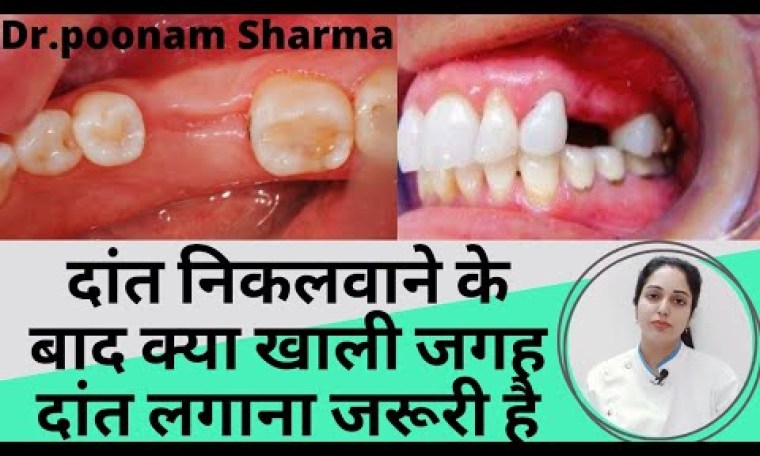 दांत निकलवाने के बाद क्या खाली जगह दांत लगवाना जरूरी है?||dant tut gaya ya nikalwa diya ab kya Karen दांत निकलवाने के बाद क्या खाली जगह दांत लगवाना जरूरी है?||dant tut gaya ya nikalwa diya ab kya Karen