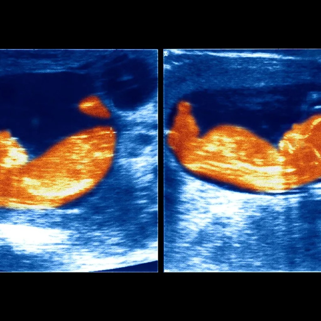 « Peut-être qu’inconsciemment, je savais »: ces deux jumelles découvrent quarante ans après qu’elles ne sont pas nées du même père « Peut-être qu’inconsciemment, je savais »: ces deux jumelles découvrent quarante ans après qu’elles ne sont pas nées du même père