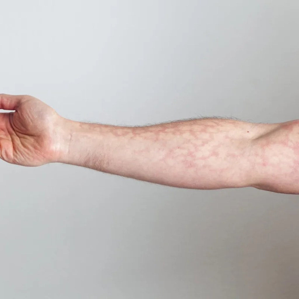 Peau marbrée : faut-il s’inquiéter ? Peau marbrée : faut-il s’inquiéter ?