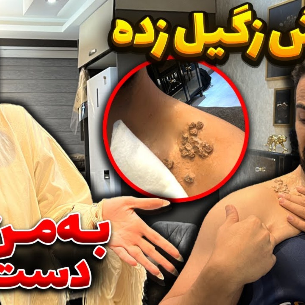 گردن رضا زگیل زده گردن رضا زگیل زده