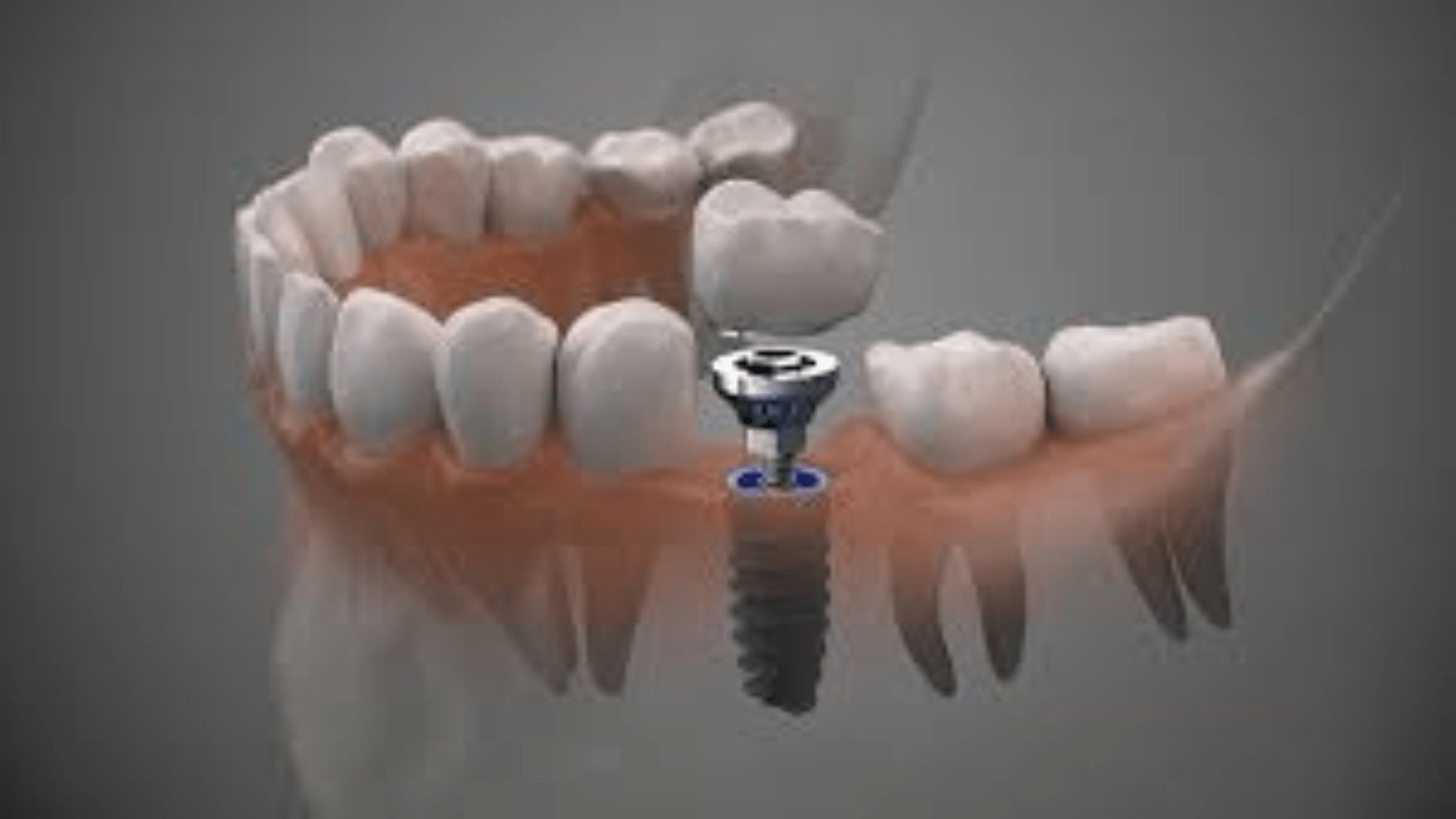 dental implants aftercare dental implants aftercare