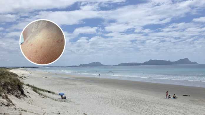 Jellyfish Invasion: Ruakākā Beachgoers Suffer Painful Stings Jellyfish Invasion: Ruakākā Beachgoers Suffer Painful Stings