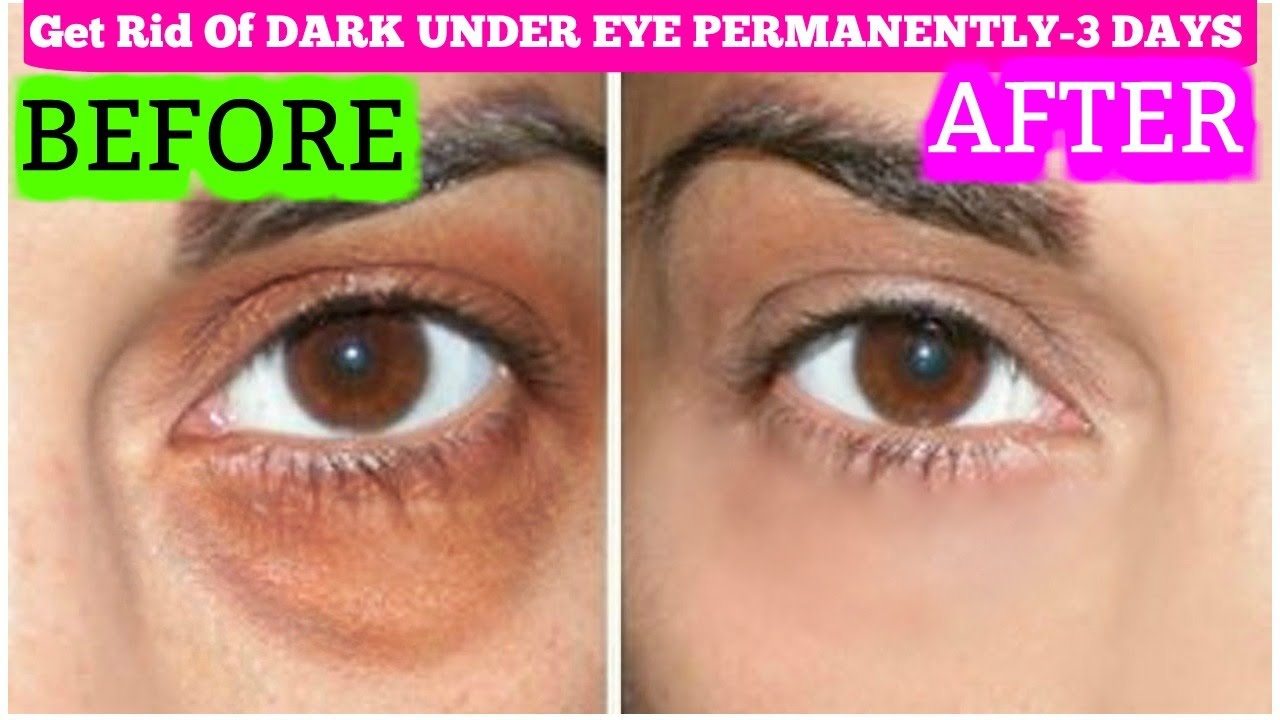 How To Get Rid Of Dark Rings Under Eyes Fast How To Get Rid Of Dark Rings Under Eyes Fast