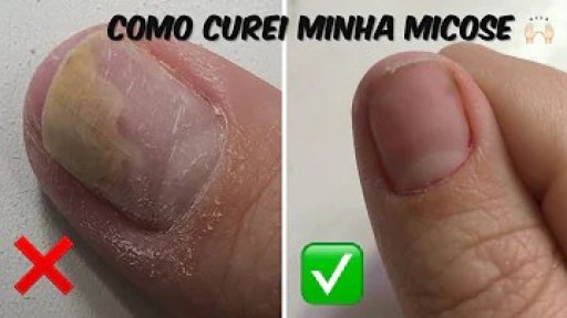 O que fazer quando a unha está caindo? O que fazer quando a unha está caindo?