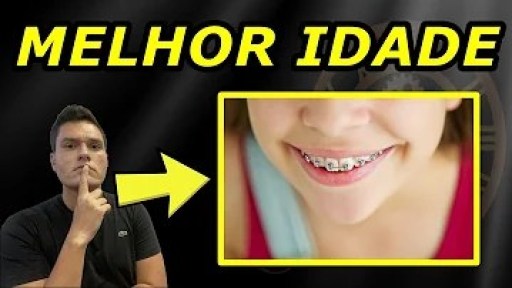 Qual é a melhor idade para usar aparelho? Qual é a melhor idade para usar aparelho?