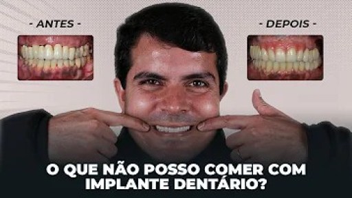 Pode comer feijão depois de fazer clareamento dental? Pode comer feijão depois de fazer clareamento dental?