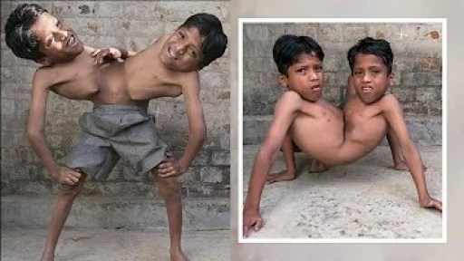 O que são irmãos siameses? O que são irmãos siameses?