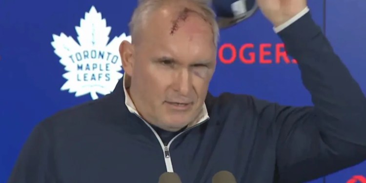 Craig Berube shows cut from gym accident Craig Berube shows cut from gym accident