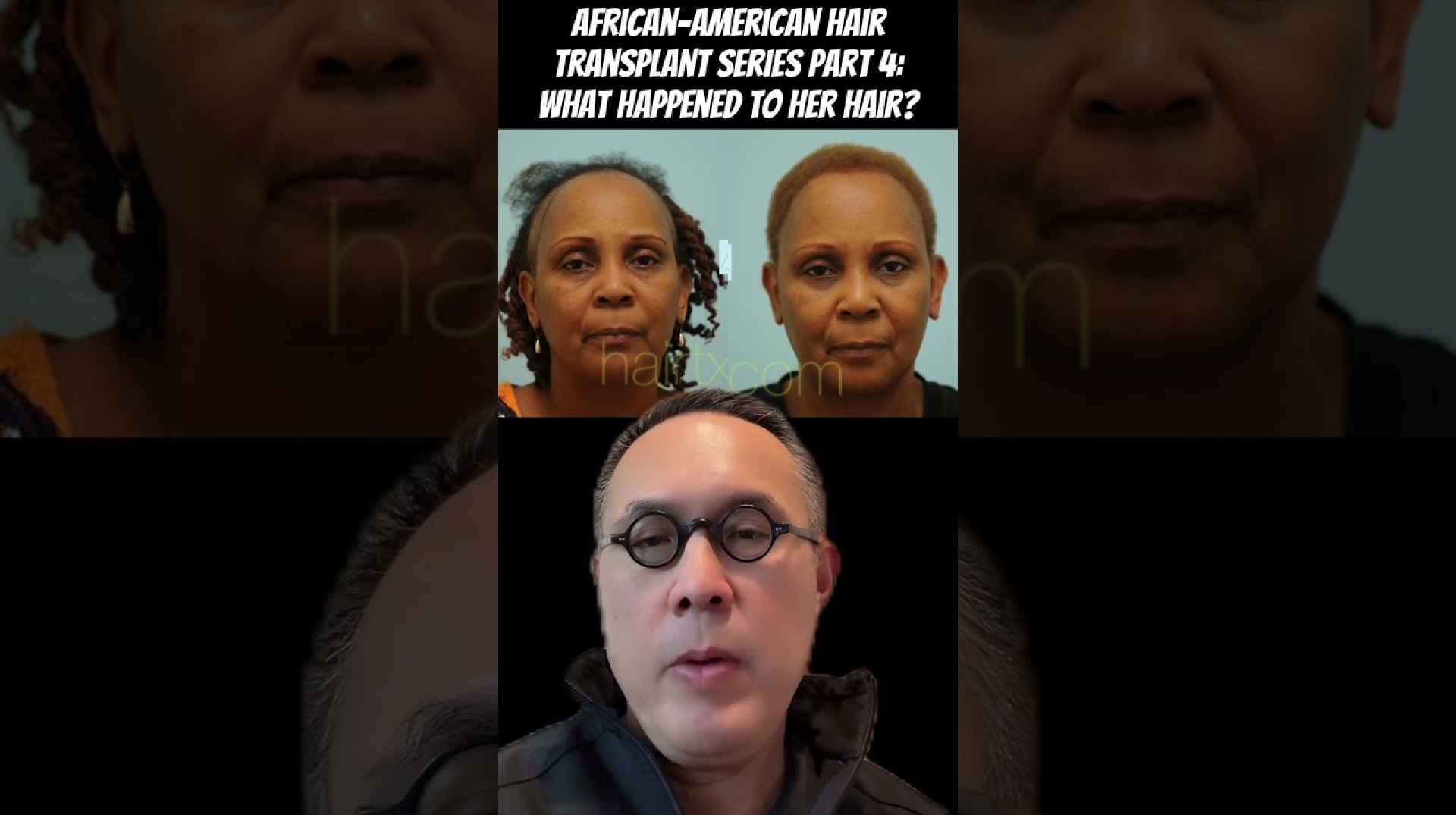 African-American Hair Transplant Series Part 4: What happened to her hair? African-American Hair Transplant Series Part 4: What happened to her hair?