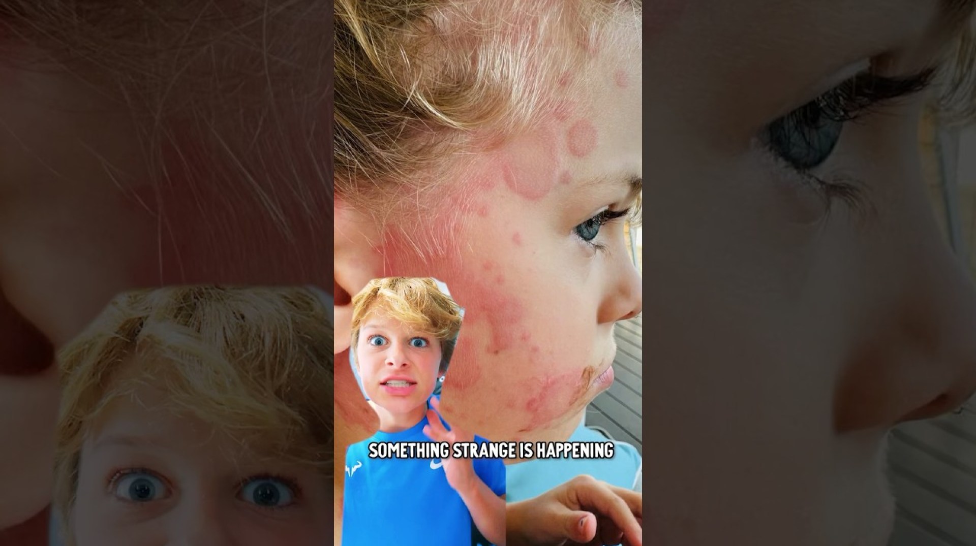 Brother's Strange Rash on face. What is it? #norrisnuts Brother's Strange Rash on face. What is it? #norrisnuts
