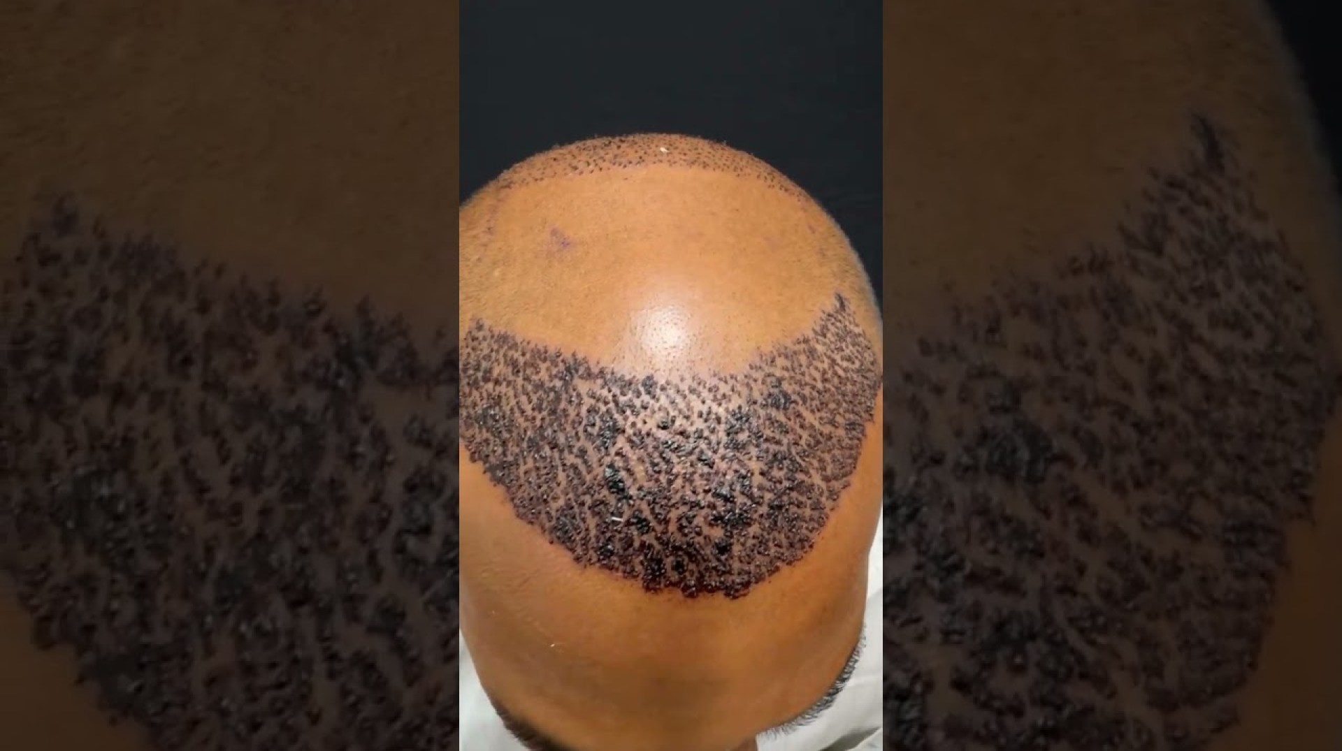 Hair transplant surgery Hair transplant surgery