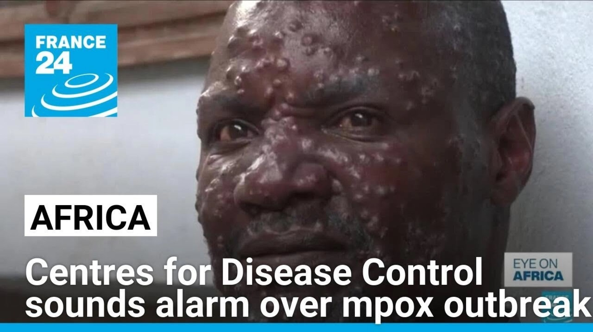 Africa's top health body sounds alarm over mpox outbreak • FRANCE 24 English Africa's top health body sounds alarm over mpox outbreak • FRANCE 24 English