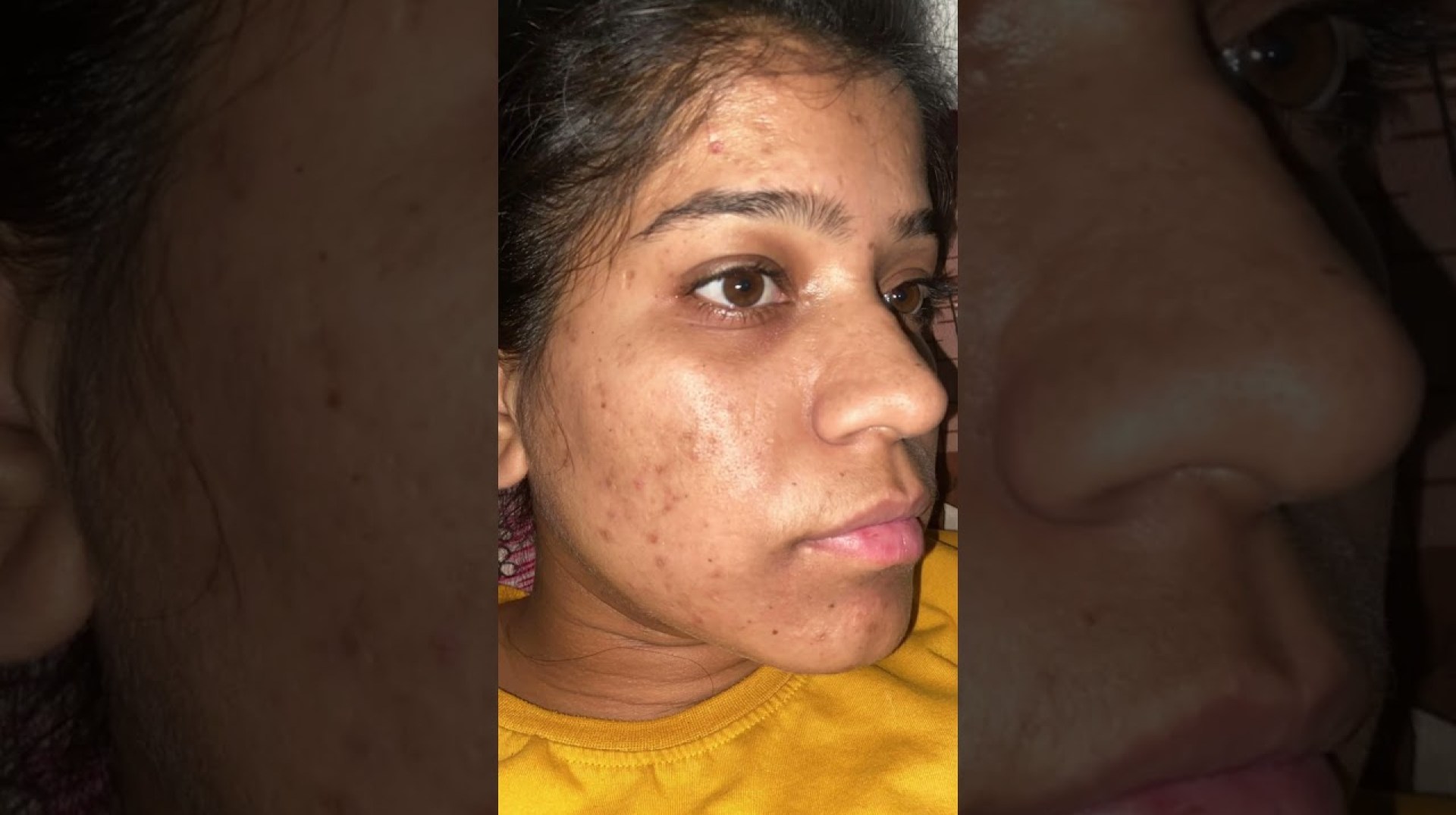 Tretinoin cream 0.025% transformation No acne No dark spot #acne #skincare #tretinoin #darkspots Tretinoin cream 0.025% transformation No acne No dark spot #acne #skincare #tretinoin #darkspots