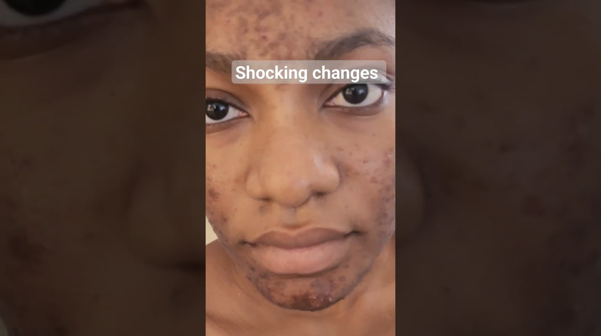 #acnes #skincareroutine #skincare #acne #pimples #Accra #kumasi #Ghana #acnes #skincareroutine #skincare #acne #pimples #Accra #kumasi #Ghana