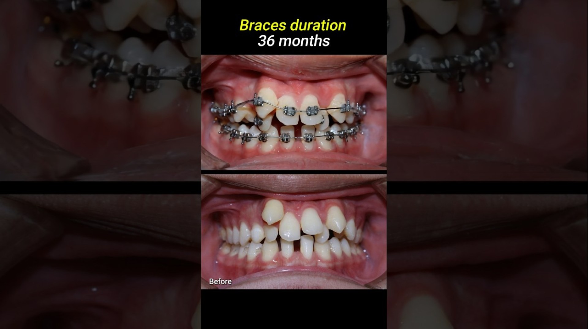 Braces for crowded teeth #braces #orthodontist #dentistry #dentist Braces for crowded teeth #braces #orthodontist #dentistry #dentist