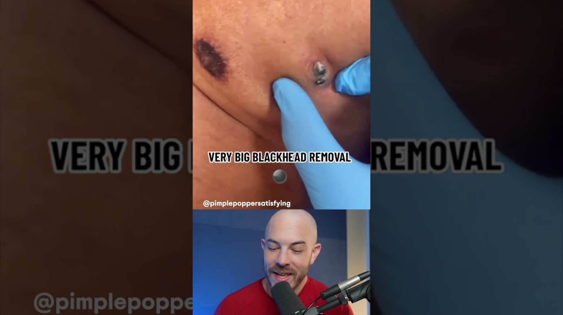 GIANT blackhead removal! #dermreacts #blackheadremoval #acneremoval GIANT blackhead removal! #dermreacts #blackheadremoval #acneremoval