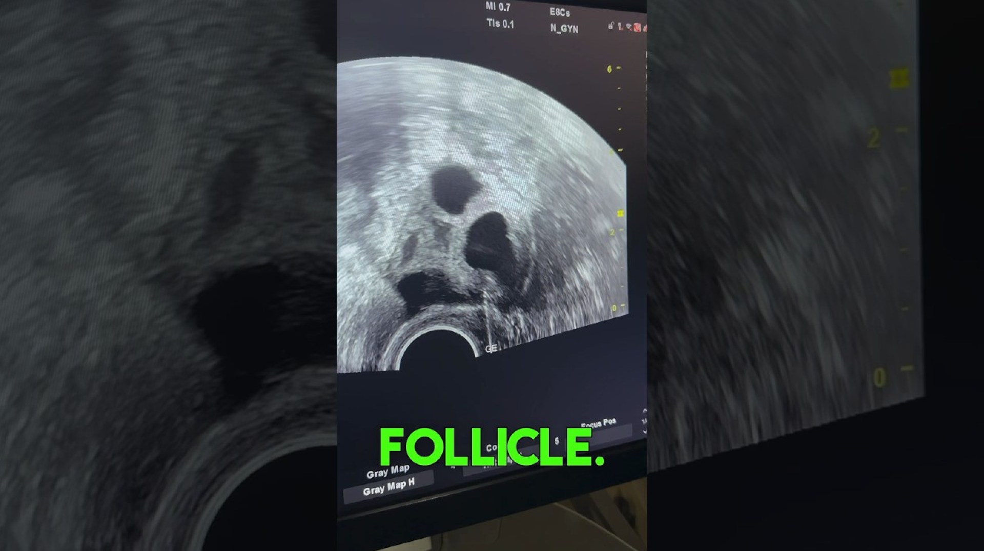 IVF picking of an Ovum: A Microscopic Journey#drsuniljindal #dranshujindal IVF picking of an Ovum: A Microscopic Journey#drsuniljindal #dranshujindal
