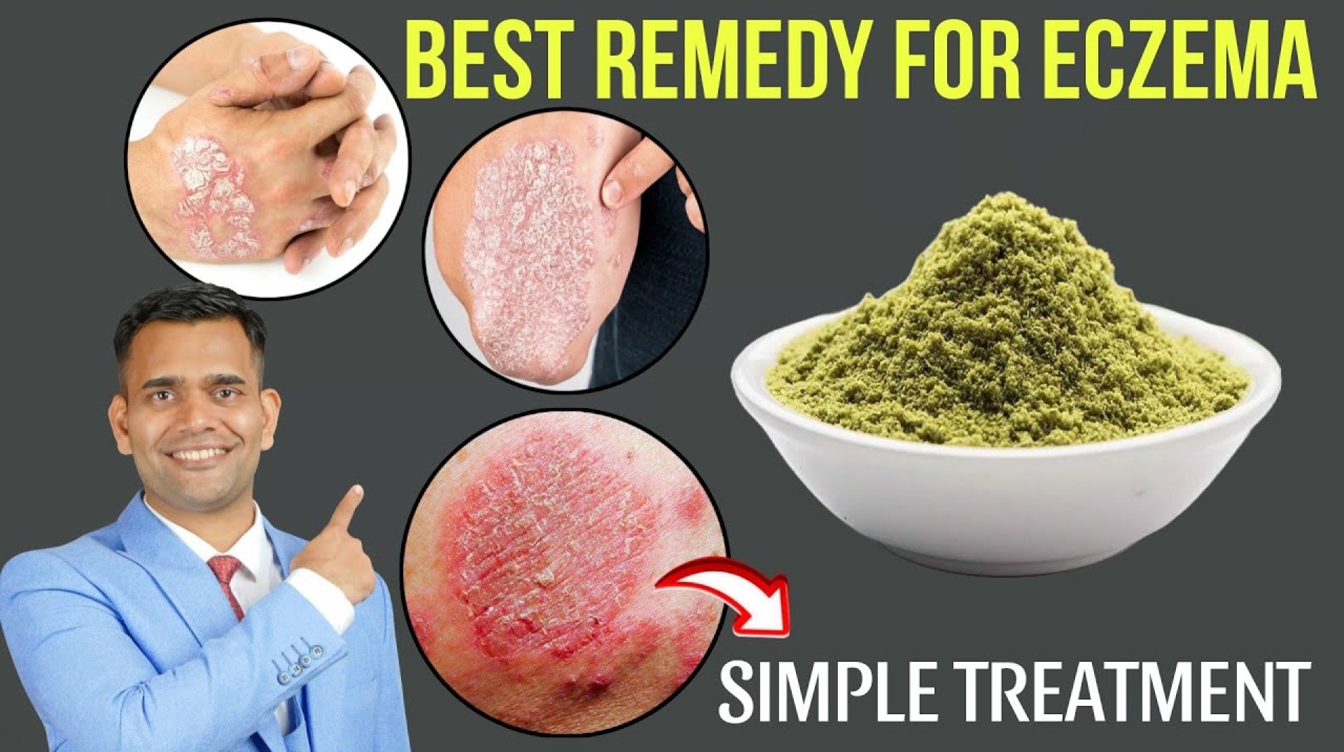 Best Natural Treatment For Eczema | How To Get Rid Of Eczema Naturally – Dr. Vivek Joshi Best Natural Treatment For Eczema | How To Get Rid Of Eczema Naturally – Dr. Vivek Joshi