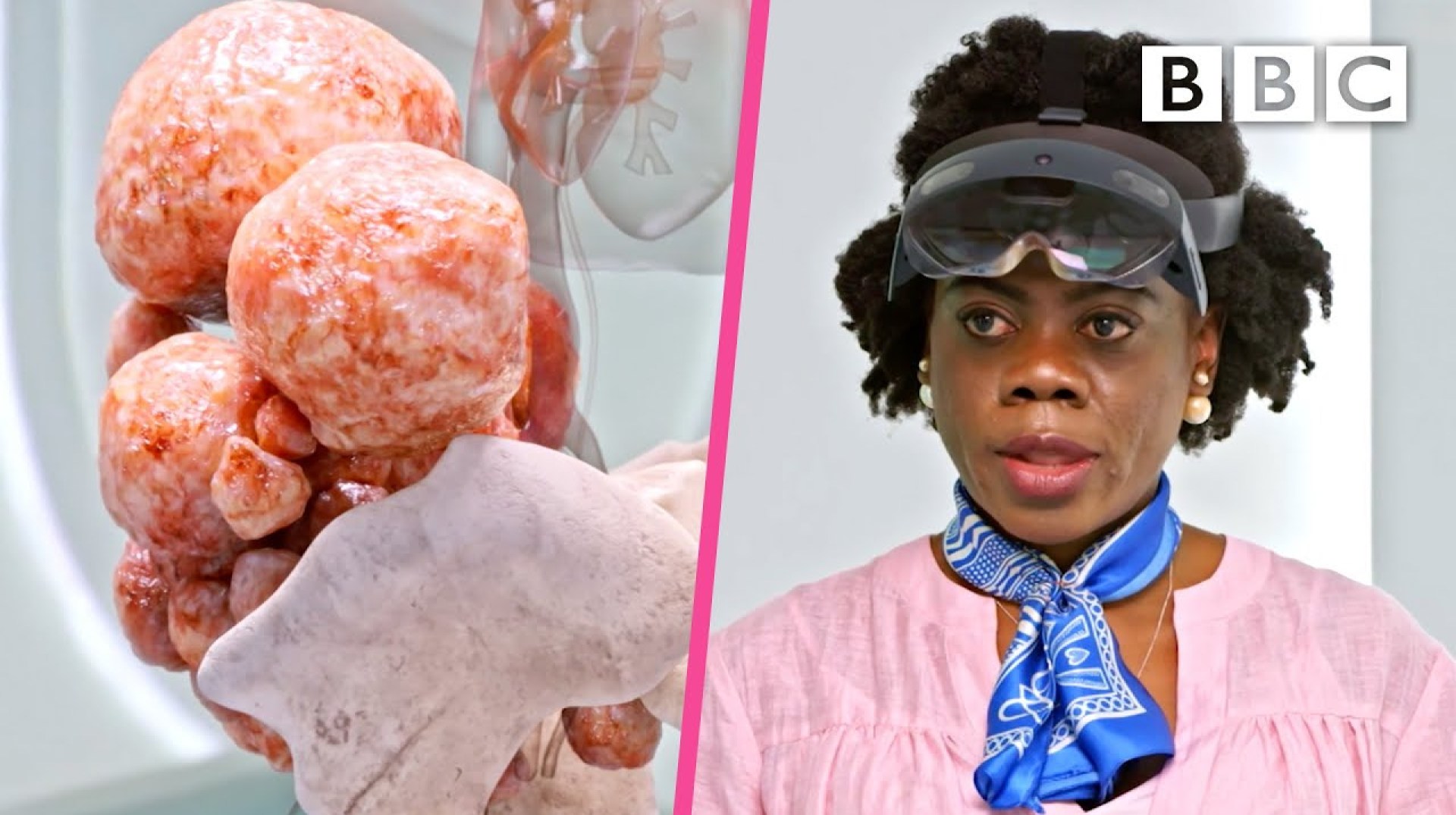 Incredible surgery to remove over 100 fibroids | Your Body Uncovered With Kate Garraway – BBC Incredible surgery to remove over 100 fibroids | Your Body Uncovered With Kate Garraway – BBC