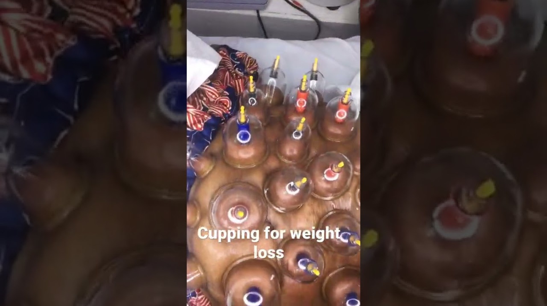 Cupping acupuncture for fat or weight loss. #fyp #ghana #viral #weightloss #fatloss Cupping acupuncture for fat or weight loss. #fyp #ghana #viral #weightloss #fatloss