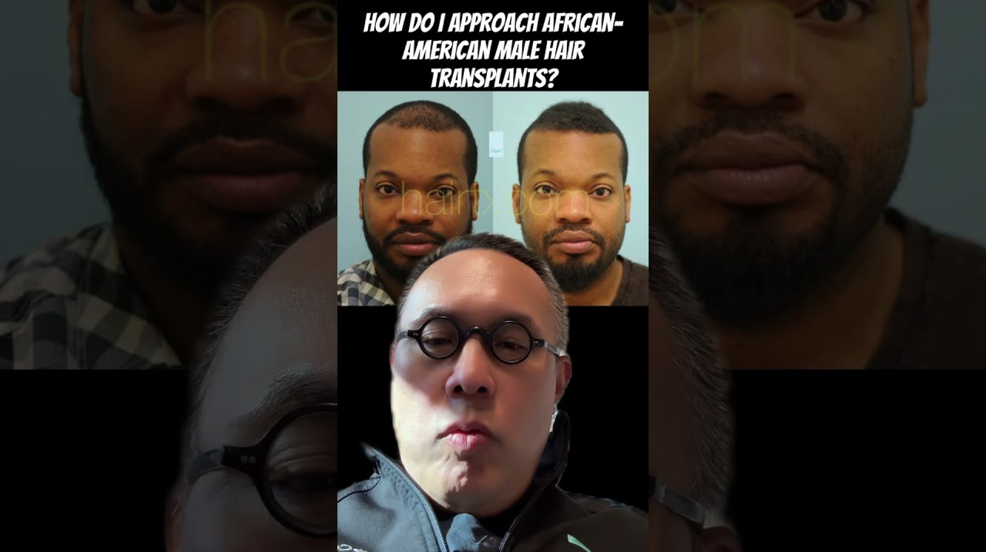 How do I approach African-American male hair transplants? How do I approach African-American male hair transplants?