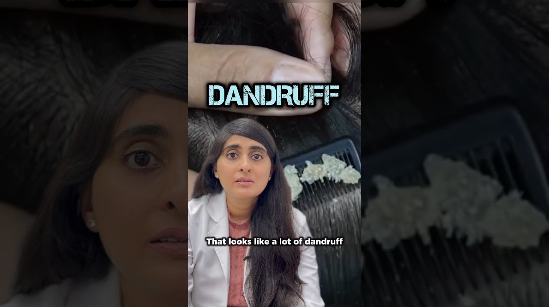 Dandruff | How to treat dandruff | Best treatment for Dandruff Dandruff | How to treat dandruff | Best treatment for Dandruff