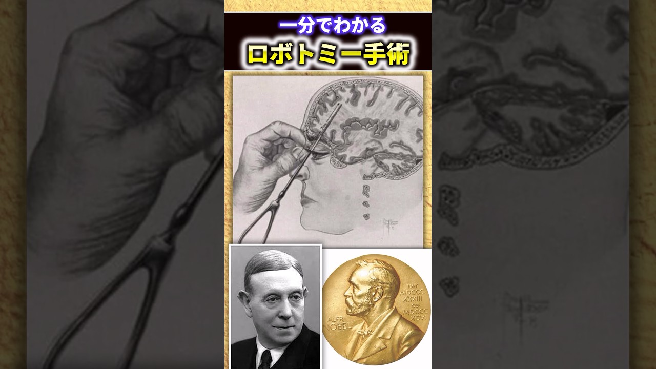 ロボトミー手術 ロボトミー手術